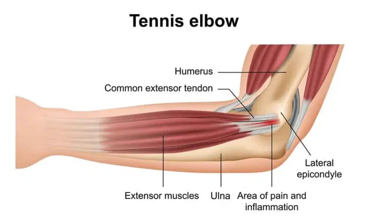 Diagram of an arm showing tennis elbow, highlighting the humerus, ulna, extensor muscles, common extensor tendon, lateral epicondyle, and area of pain and inflammation.