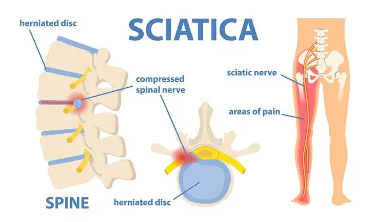 Diagram showing a herniated disc compressing a spinal nerve, with highlighted sciatic nerve and pain areas running down the leg.
