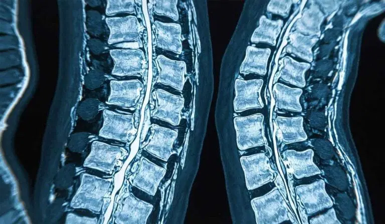 MRI scans showing detailed cross-sectional images of the human spine, highlighting vertebrae and intervertebral discs in different orientations.